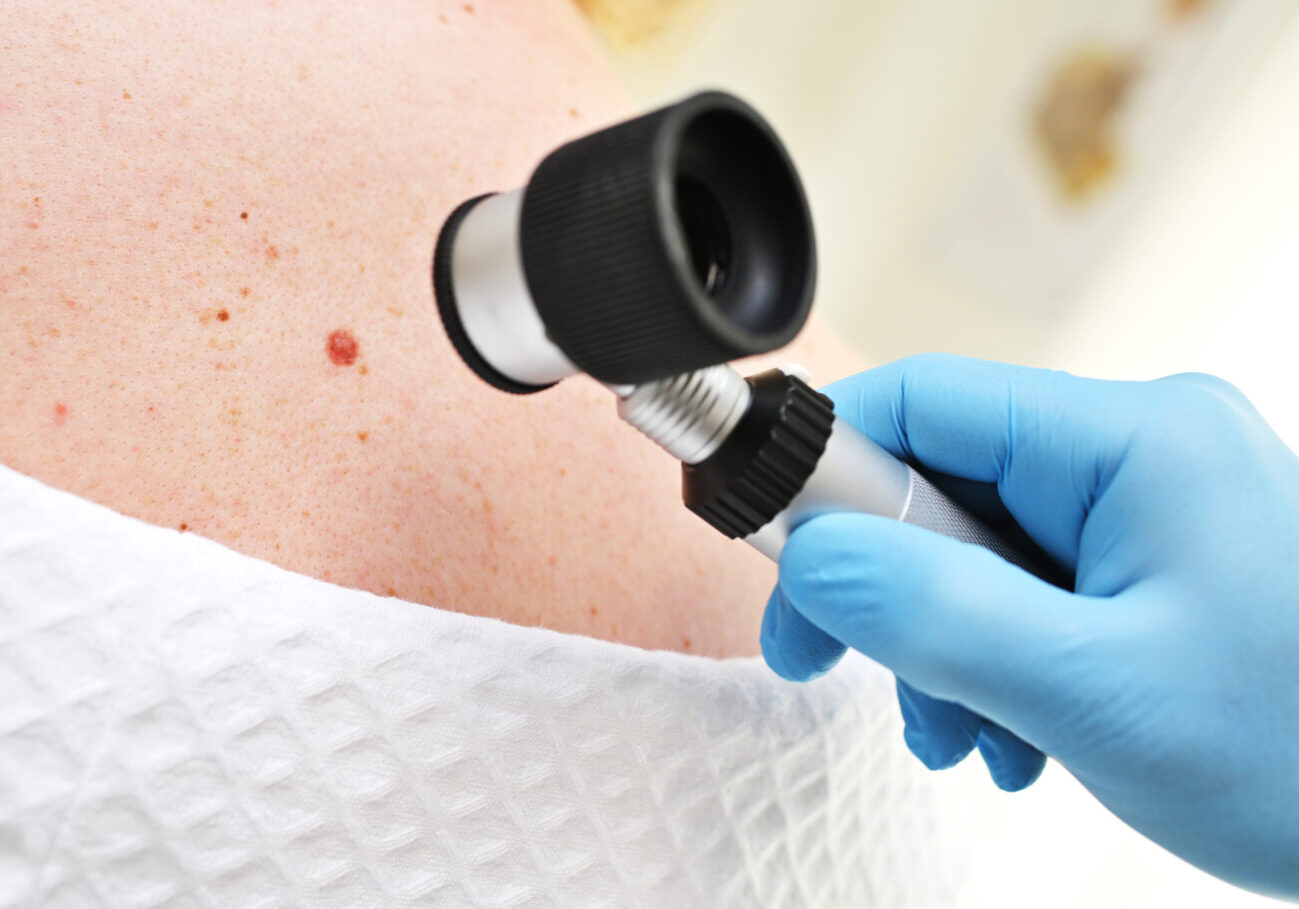 close-up - a dermatologist examines moles and skin growths on the patient's body using a special device - a dermatoscope. Diagnosis and prevention of melanoma.