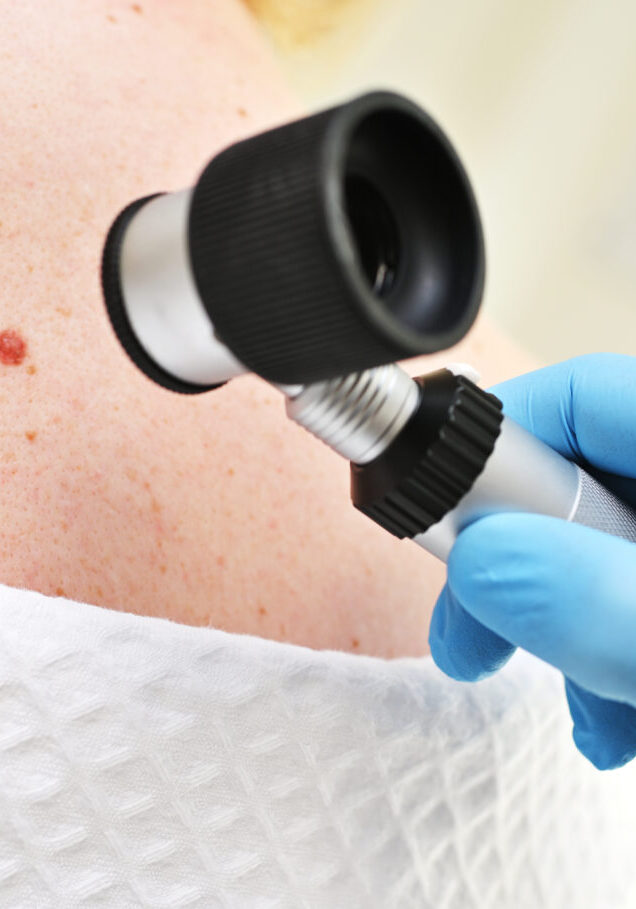 close-up - a dermatologist examines moles and skin growths on the patient's body using a special device - a dermatoscope. Diagnosis and prevention of melanoma.